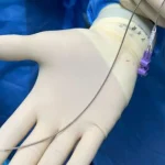 Premieră medicală de amploare la spitalul din Craiova
